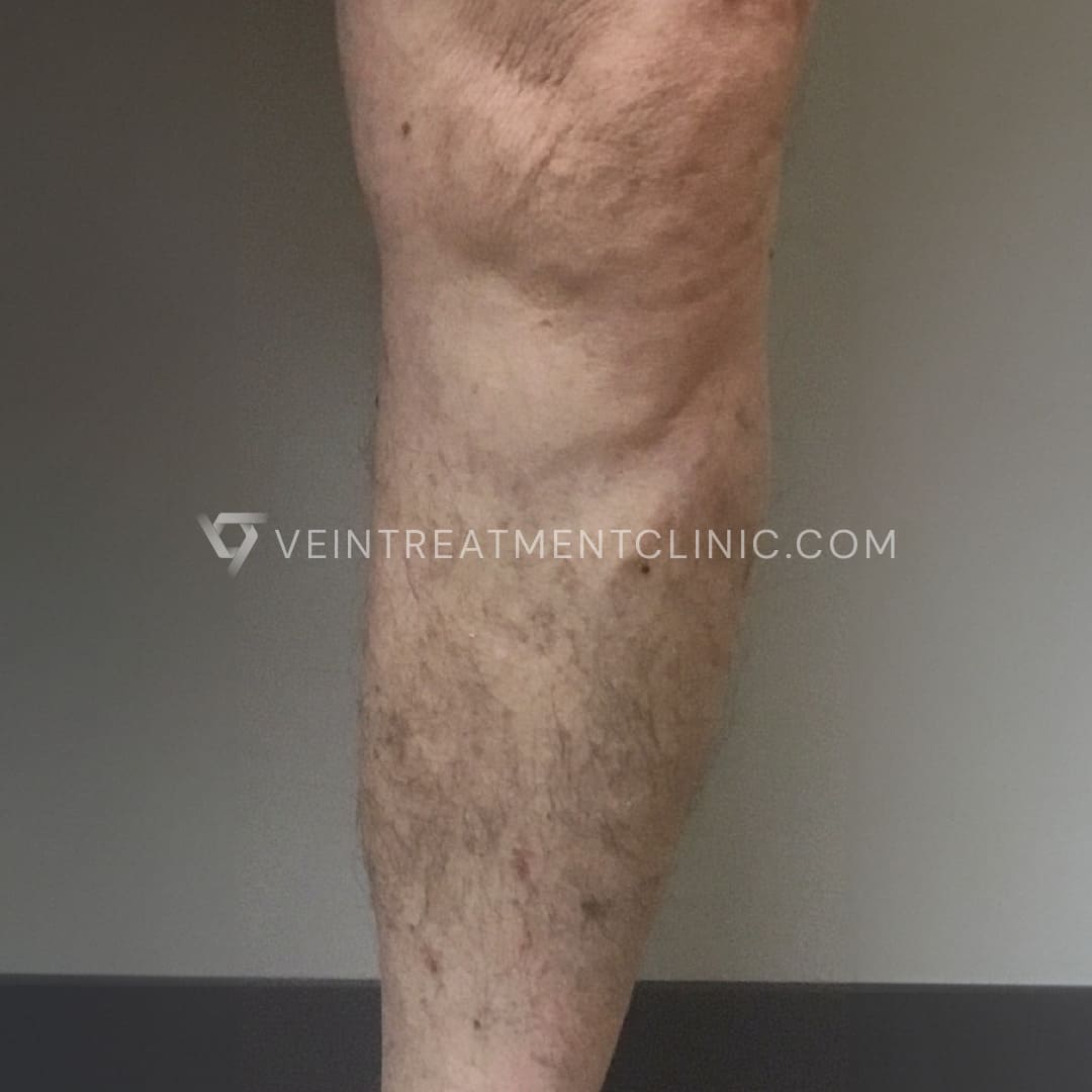 BA8_61+_SV after