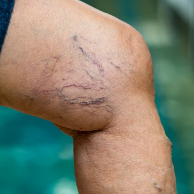Vein Vanish treat chronic venous insufficiency photo Vein Vanish treat chronic venous insufficiency photo