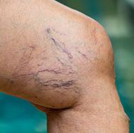 Spider veins symptoms background image