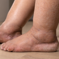 Swollen ankles symptoms background image