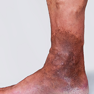 Ulcers symptoms background image