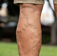 Varicose veins symptoms background image