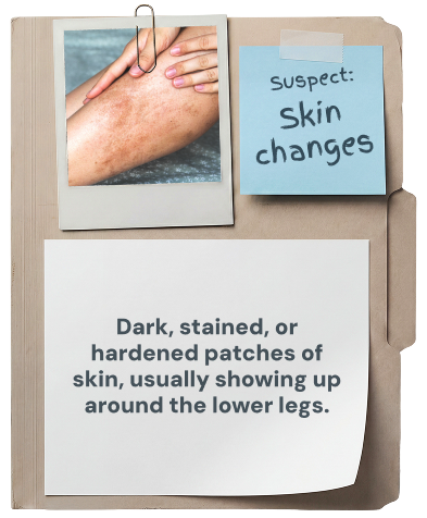 Skin changes: dark, stained, or hardened patches of skin, usually showing up around the lower legs.