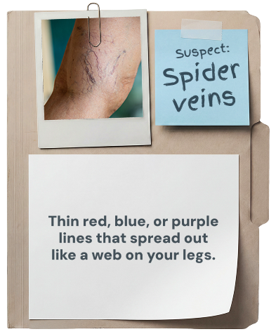 Spider veins: thin red, blue, or purple lines that spread out like a web on your legs.
