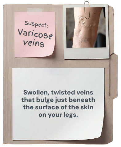 Varicose veins: swollen, twisted veins that bulge just beneath the surface of the skin on your legs.