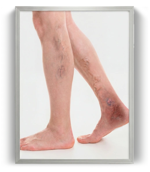 Legs showing visible signs of vein disease