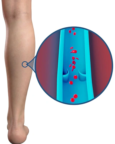 3D animation inside a leg vein: a weakened valve no longer closes, so blood flows backward and pools in the lower leg.