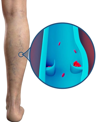 3D animation of a leg: pressured veins stretch, bulge, and branch toward the skin surface, forming visible spider and varicose veins.