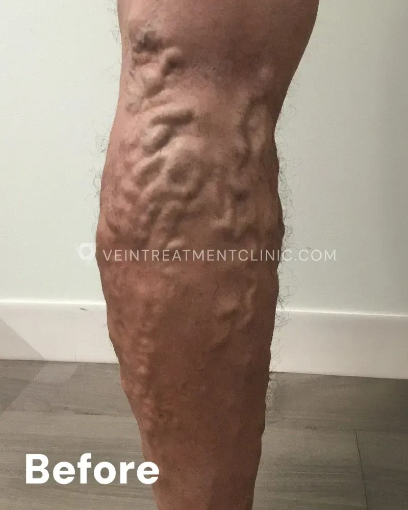 Varicose Veins — Calves & Knees before