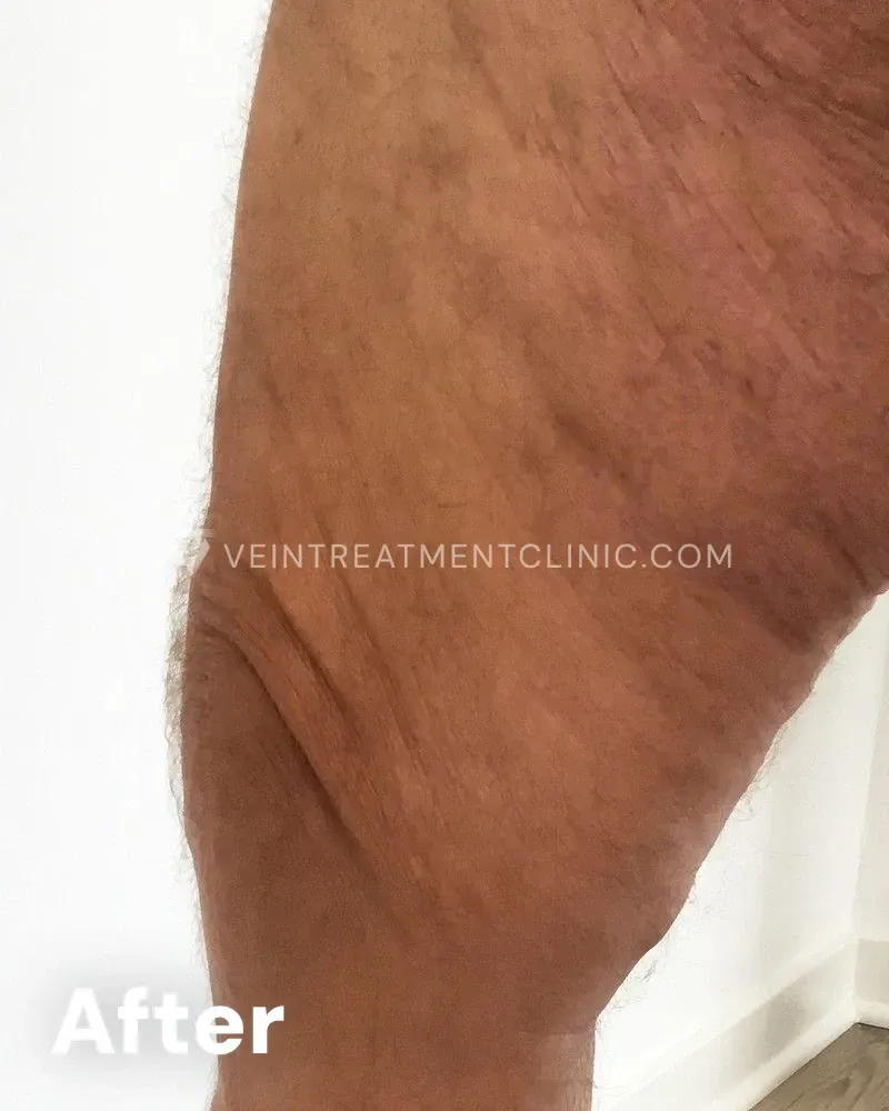 Varicose Veins — Knees & Thighs after