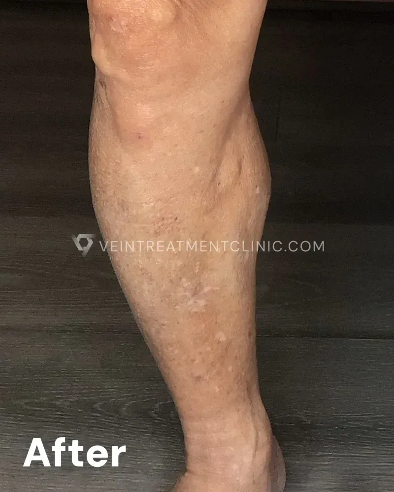 Varicose Veins — Calves & Thighs after