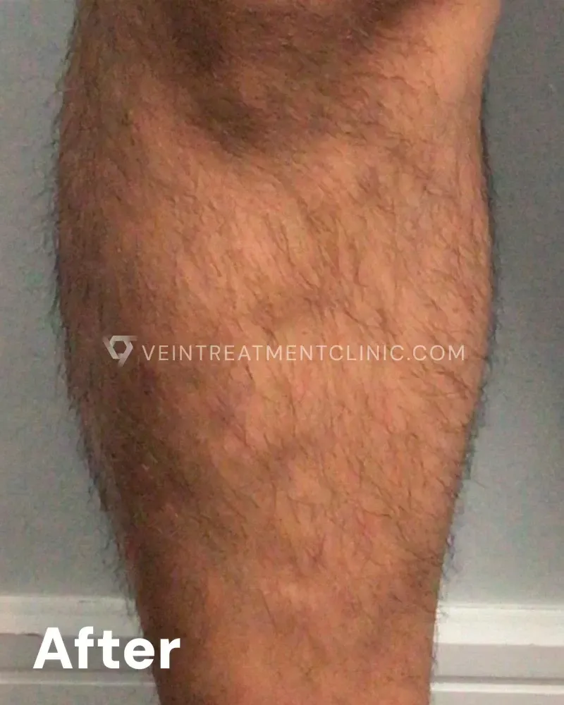 Varicose Veins — Calves after